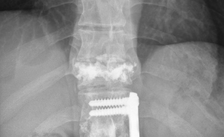 Spine