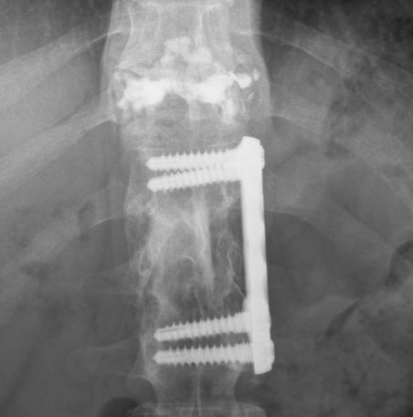 Spine